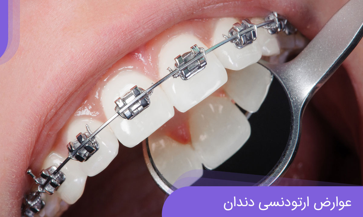 عوارض ارتودنسی دندان عوارض ارتودنسی دندان