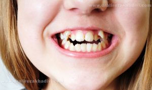 جوانه زدن غیرطبیعی دندان ها