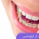 پلاک بعد از ارتودنسی