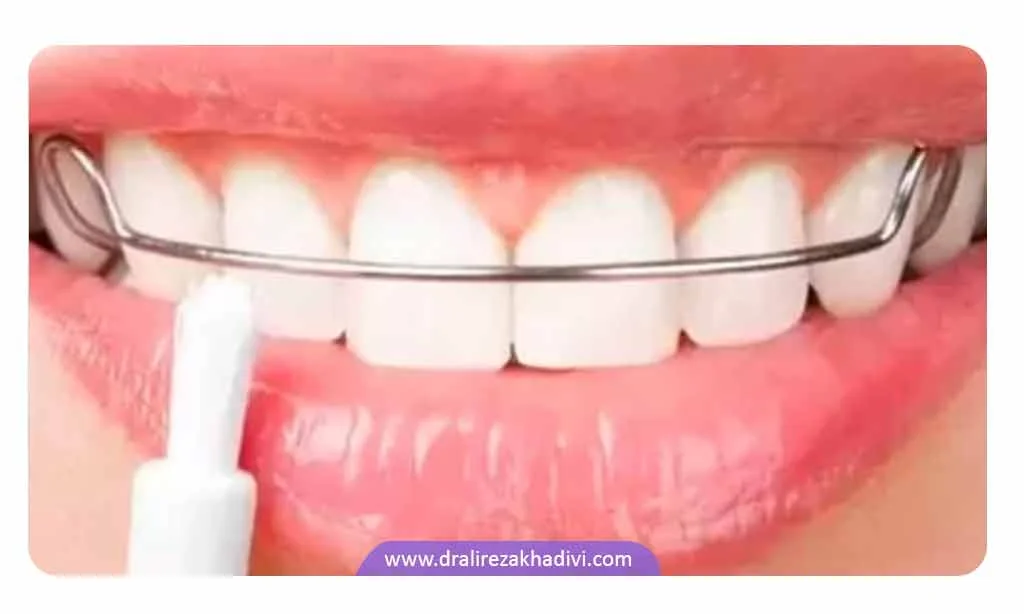 نگهدارنده دندان بعد از ارتودنسی