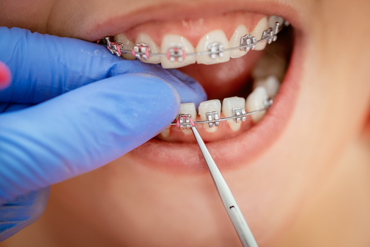 ارتودنسی دندان های حساس