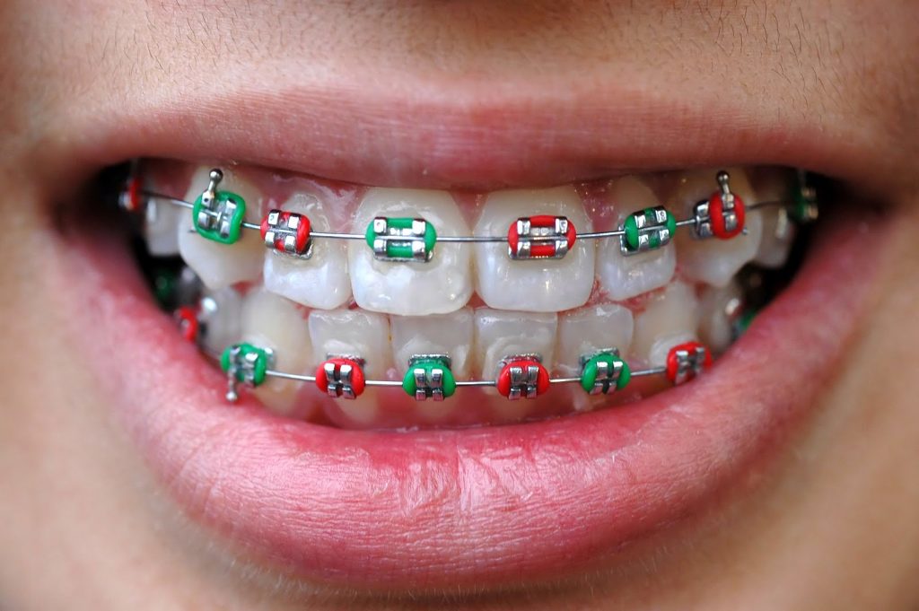 ارتودنسی و میگرن