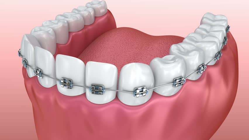 بستن فاصله بین دندان ها با ارتودنسی