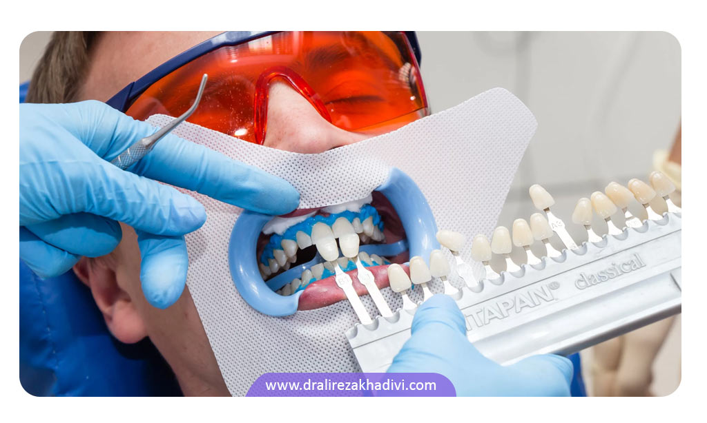 بلیچ دندان در مطب دندانپزشکی