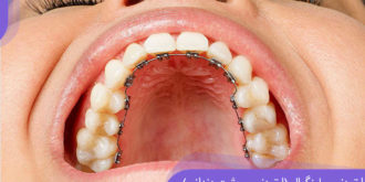 ارتودنسی لینگوال یا ارتودنسی پشت دندانی