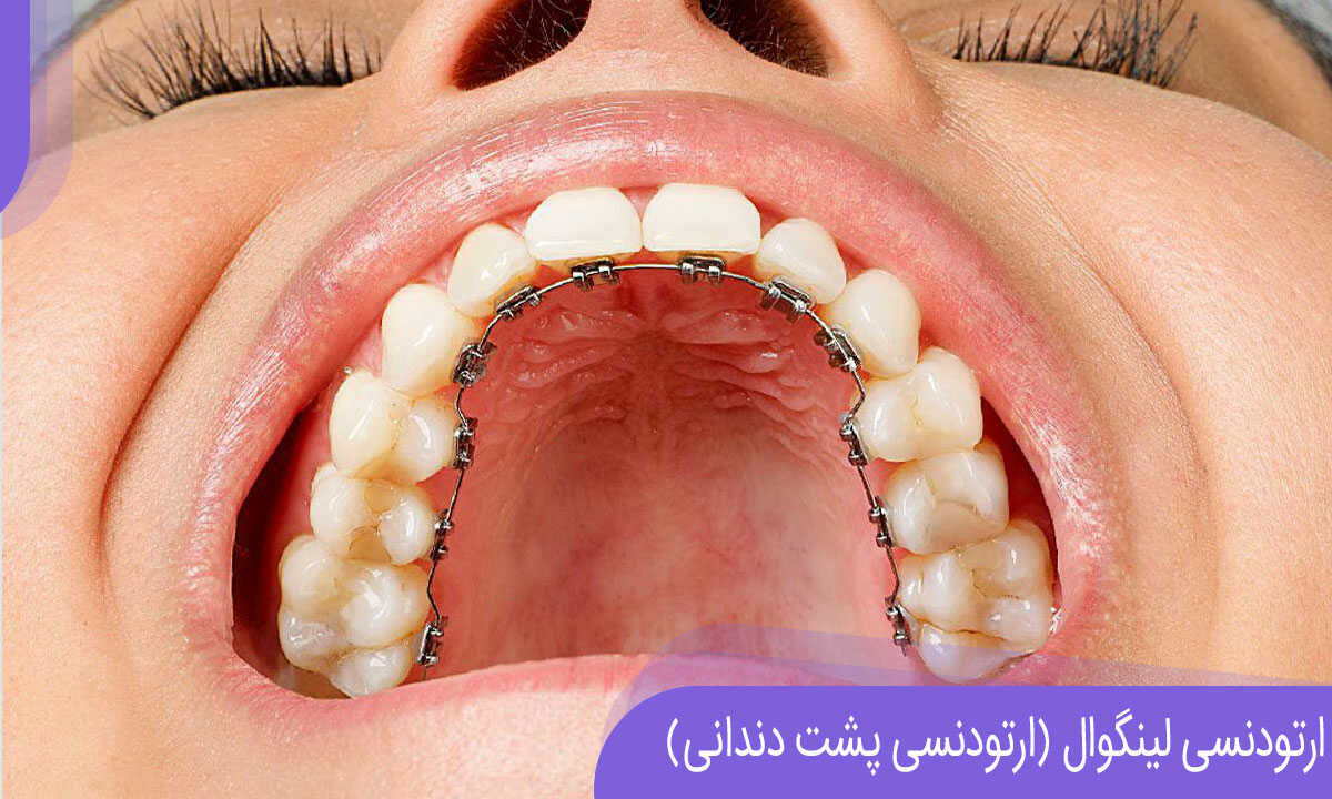 ارتودنسی لینگوال یا ارتودنسی پشت دندانی