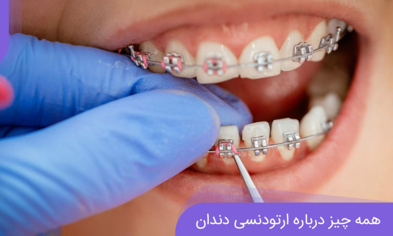 همه چیز درباره ارتودنسی دندان