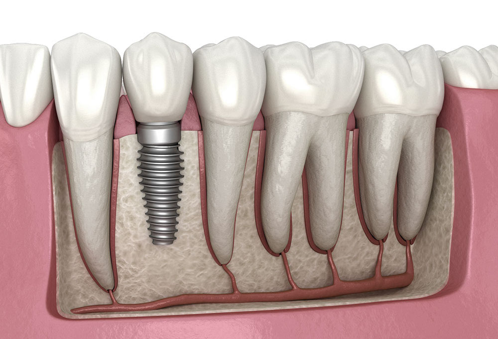ارتودنسی قبل از ایمپلنت دندان