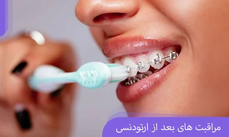 مراقبت های بعد از ارتودنسی
