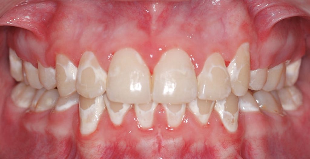 لک شدن دندان ها بعد از ارتودنسی