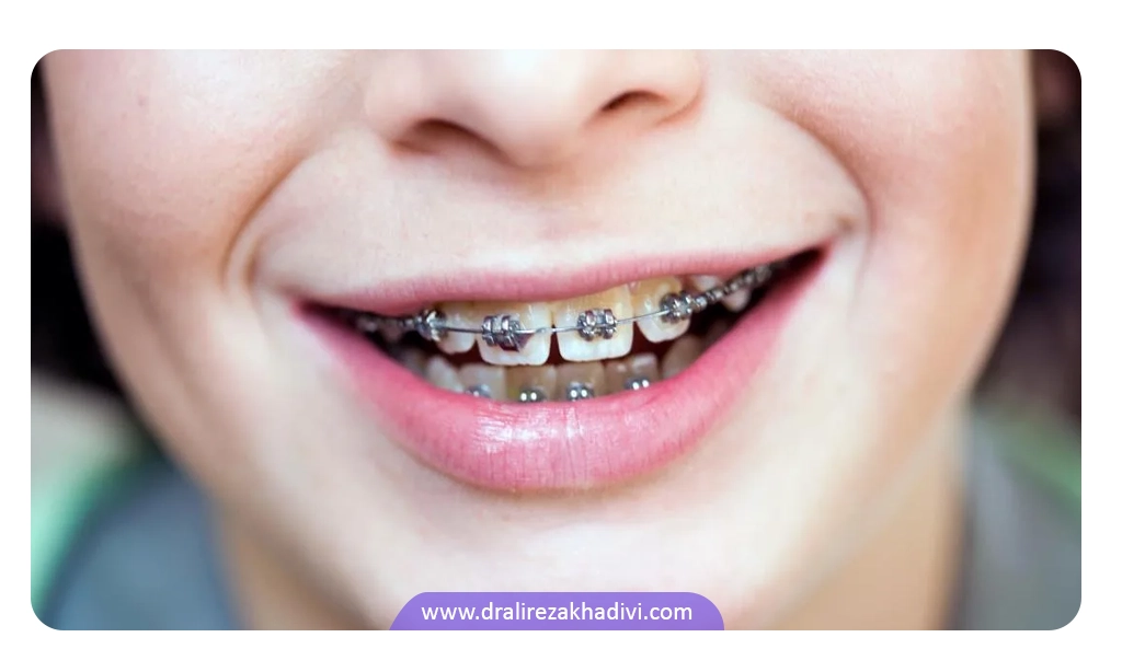 حذف دندان های پوسیده از دلایل کشیدن دندان در ارتودنسی است