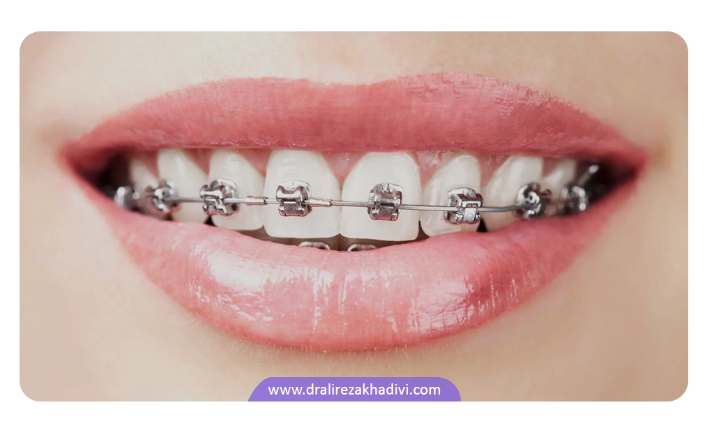 روش های جایگزین کشیدن دندان برای ارتودنسی
