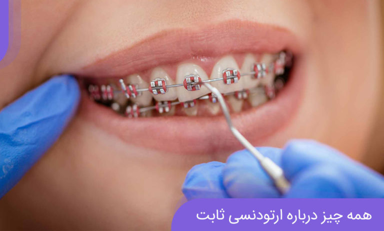 ارتودنسی ثابت