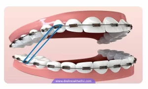 کش دندان ارتودنسی