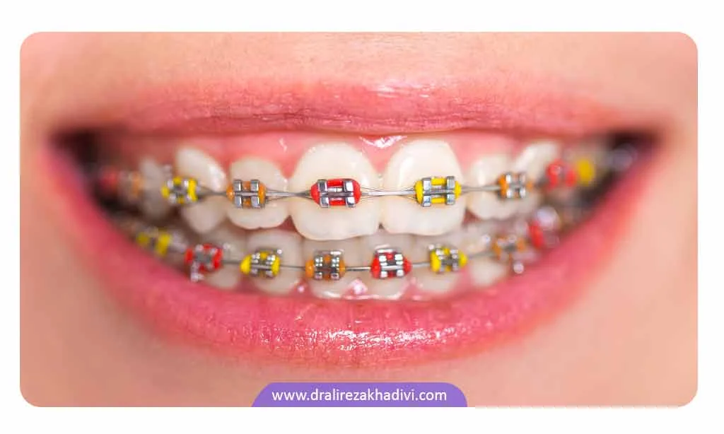 ارتودنسی رنگی را می توان در انواع رنگ ارتودنسی انتخاب و روی دندان نصب کرد.