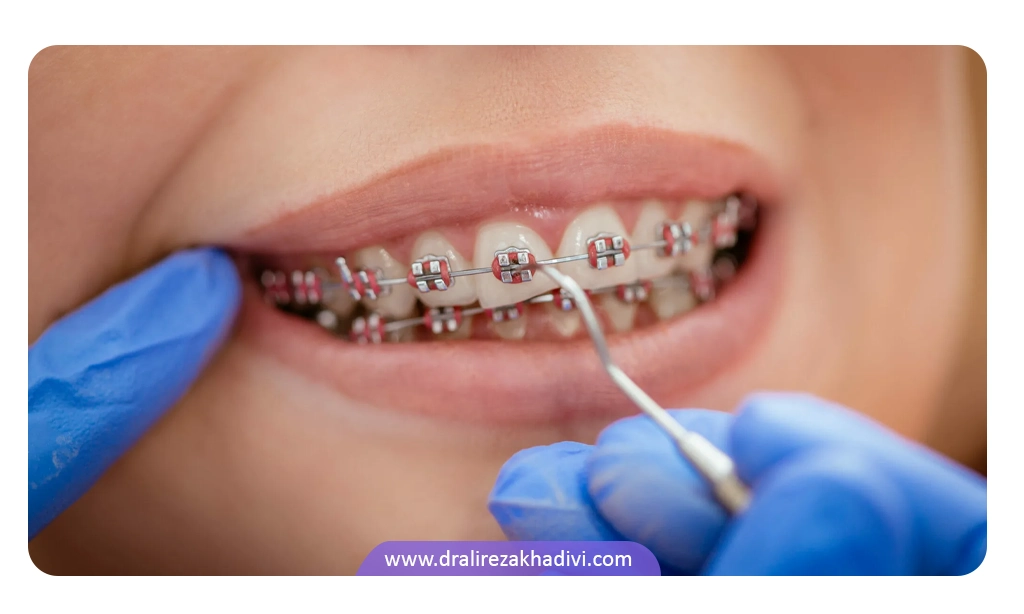 قیمت ارتودنسی دندان با توجه به نوع ارتودنسی انتخاب شده متفاوت است.