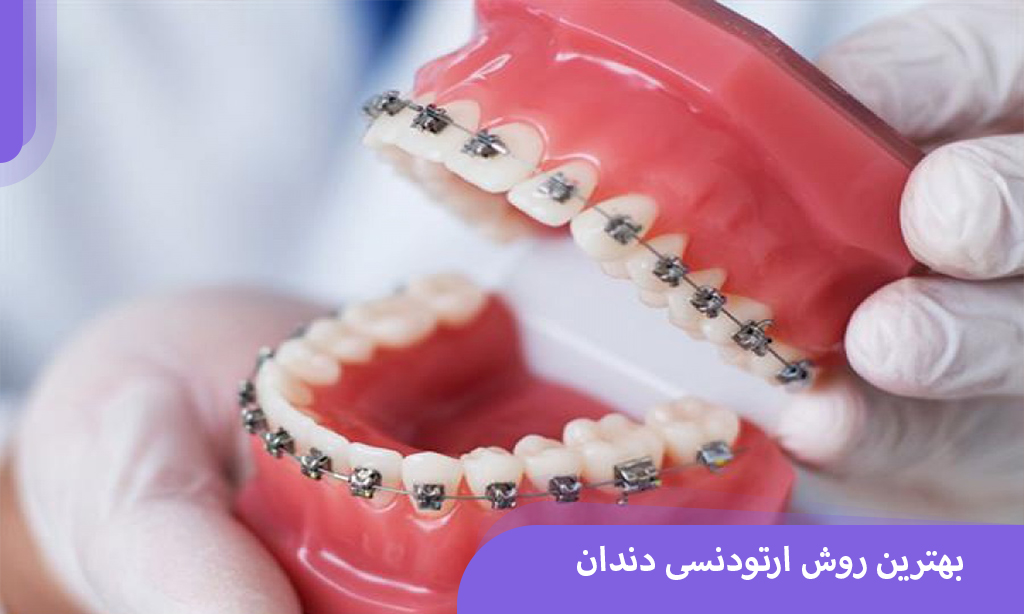 بهترین روش ارتودنسی دندان