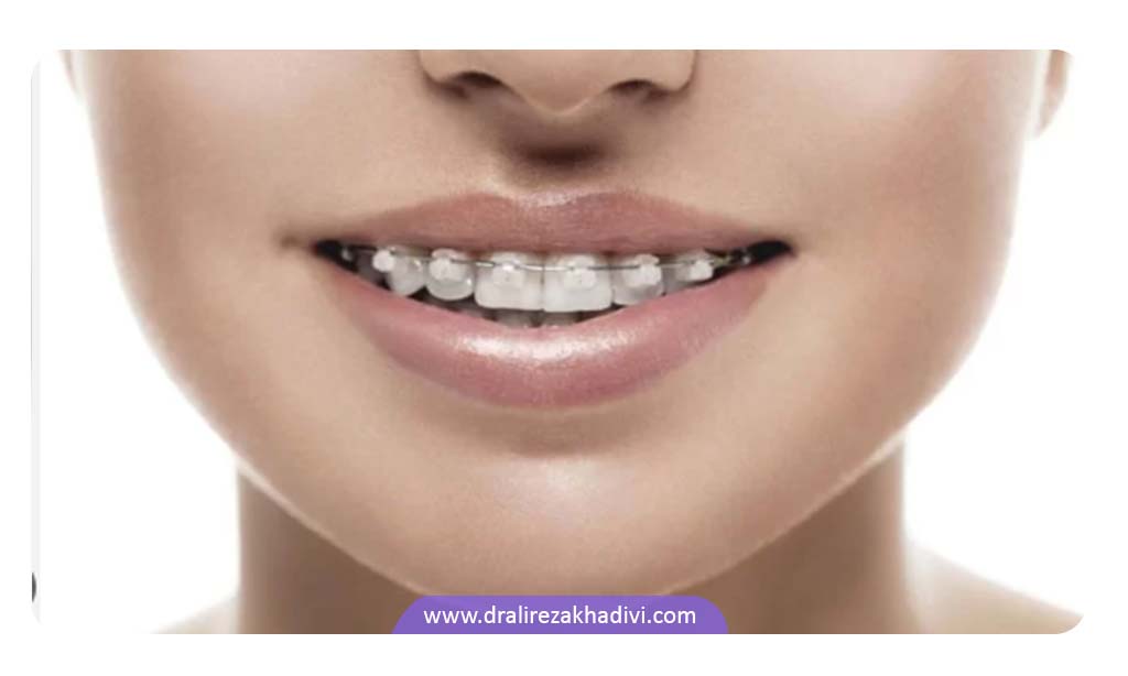 براکت سرامیکی یکی از تجهیزات ارتودنسی