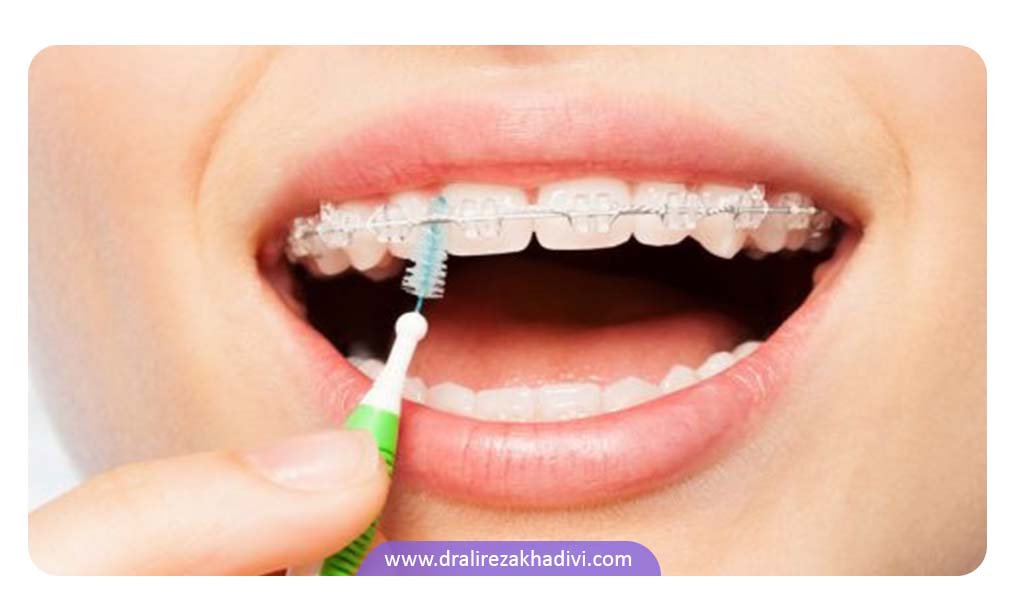 مراقبت های براکت سرامیکی