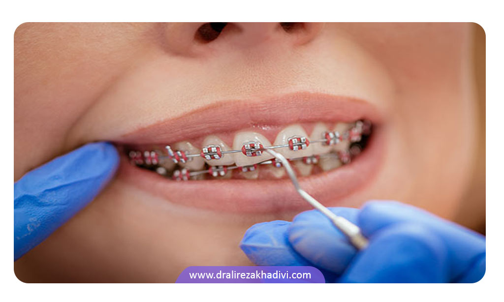 مراحل ارتودنسی دندان کودکان