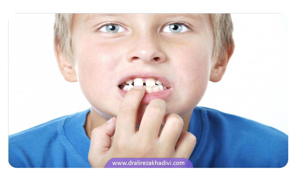 درمان فاصله دندان های جلو