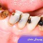 برای جلوگیری از پوسیدگی دندان چه بخوریم و چکار کنیم