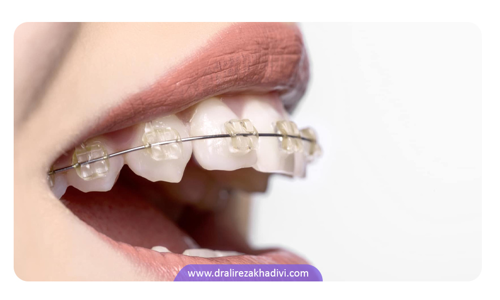 ارتودنسی نامرئی سرامیکی مشابه نمونه های ثابت در اصلاح دندان است