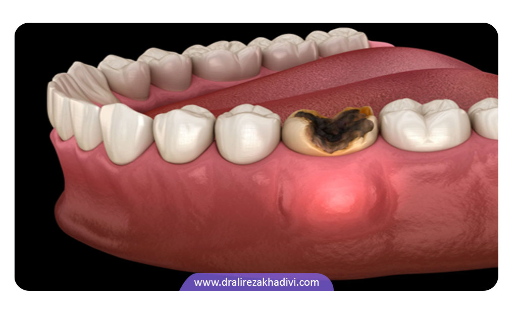 درمان آبسه دندان