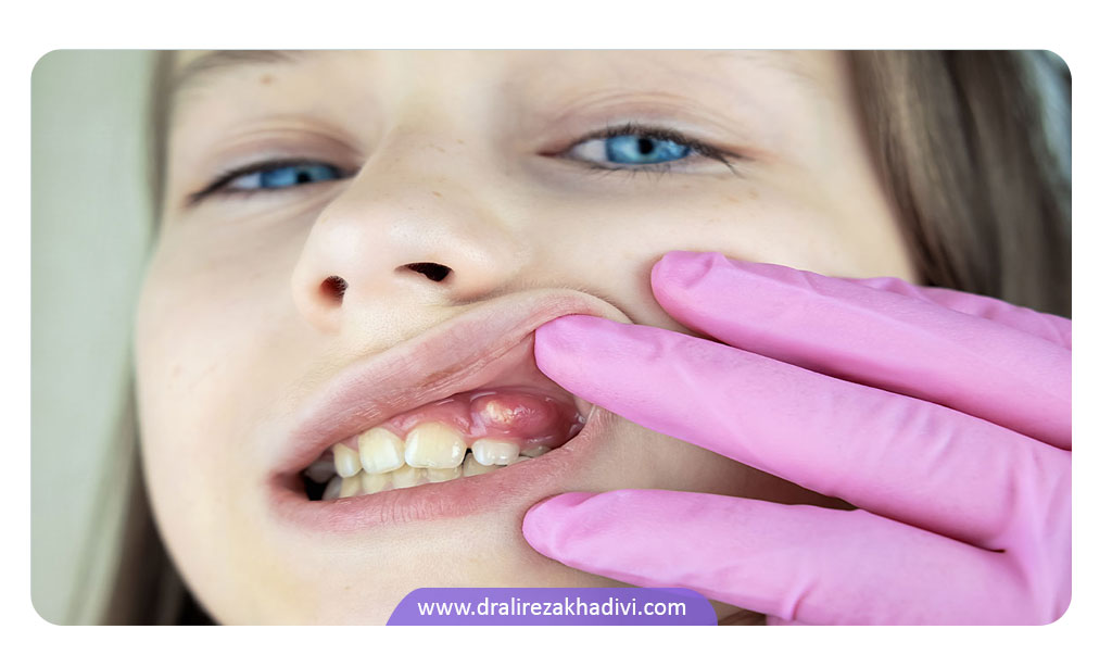راه های کلینیکی درمان ابسه دندان