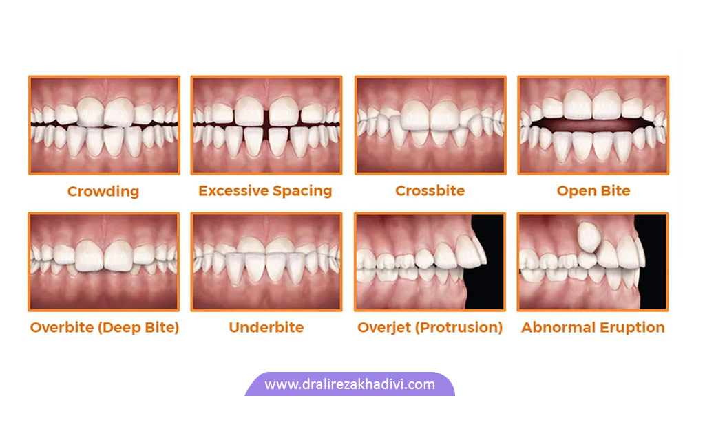 مشکلاتی که به ارتودنسی نیاز دارند