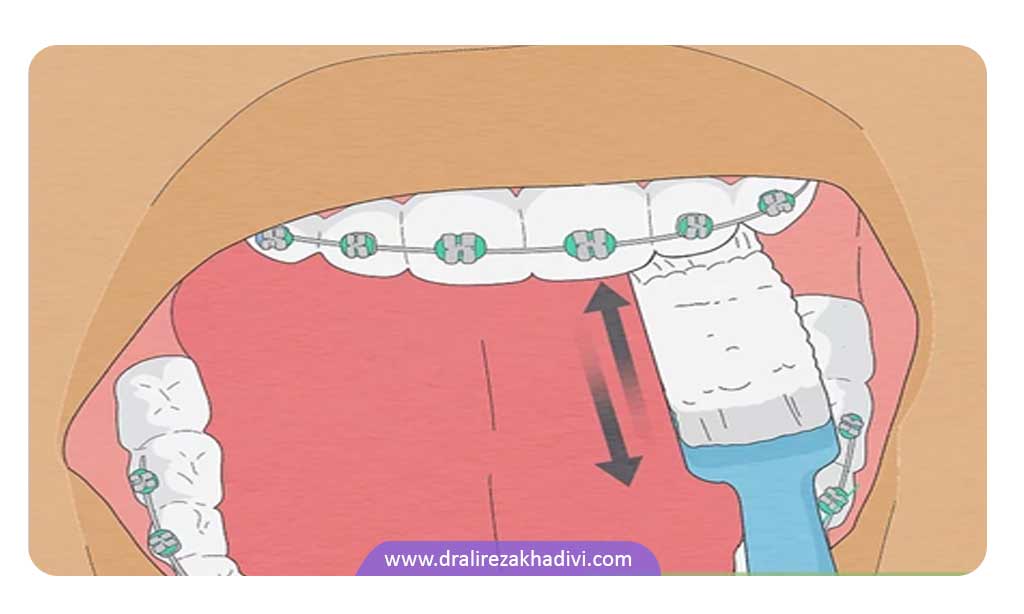 نحوه مسواک زدن ارتودنسی