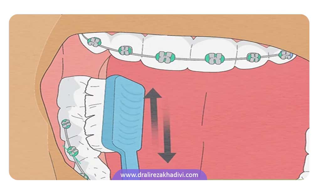 طرز مسواک زدن ارتودنسی