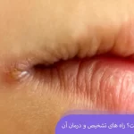 زخم گوشه لب