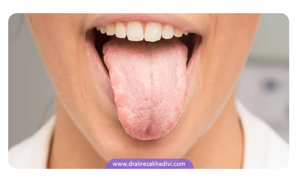 عکس زخم دهان زبان سیاه مودار