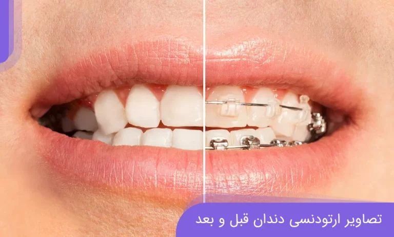 تصاویر ارتودنسی دندان قبل و بعد