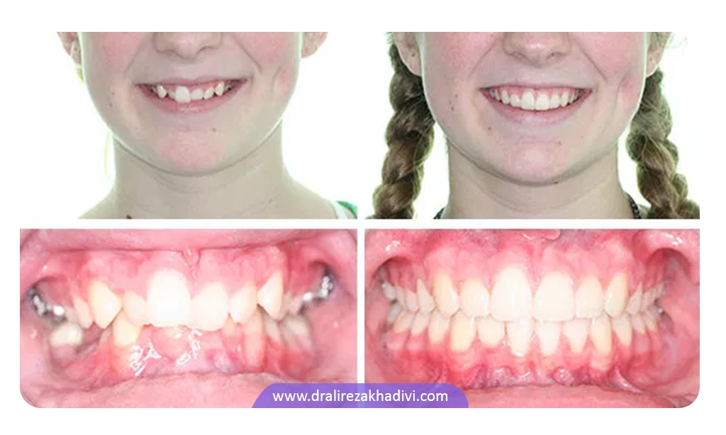 عکس طرح دندان قبل و بعد از ارتودنسی