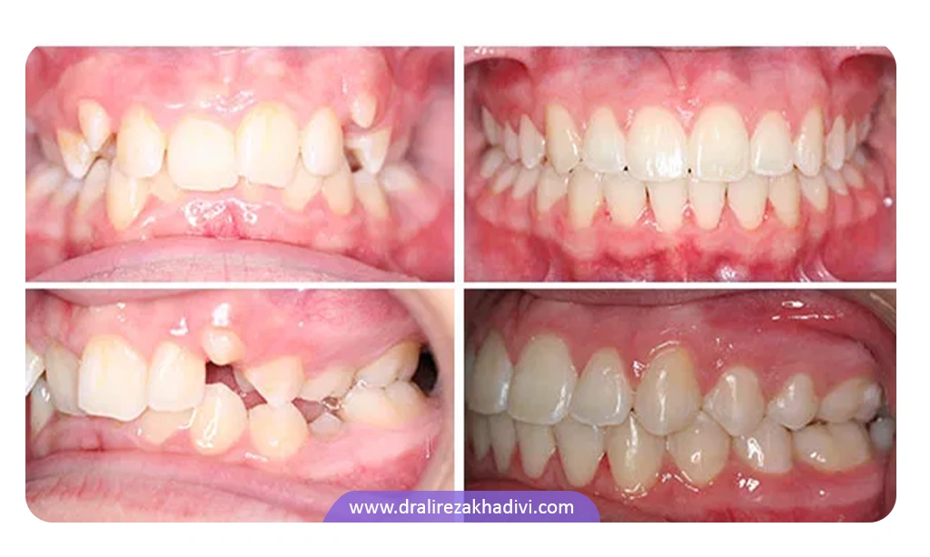 نمونه جلوگیری از ازدحام دندانی با ارتودنسی
