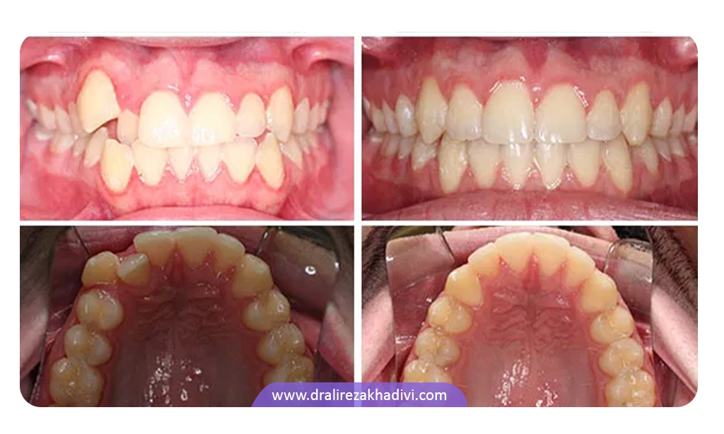 نمونه قبل و بعد ارتودنسی در برطرف کردن ناهنجاری و بهم ریختگی دندان