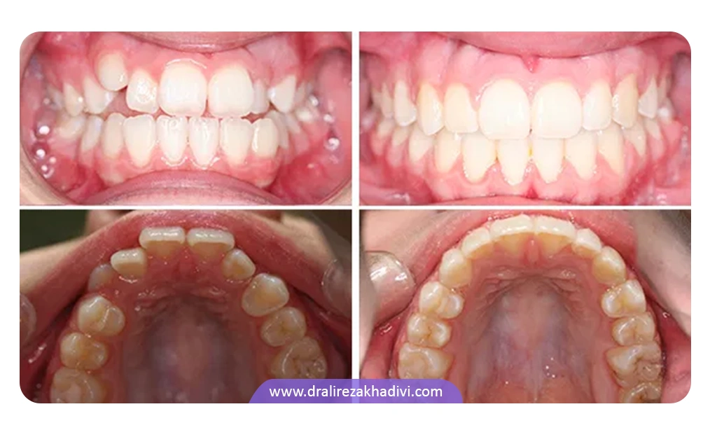 ارتودنسی قبل و بعد دندان خرگوشی که بعد از ارتودنسی مرتب شده است