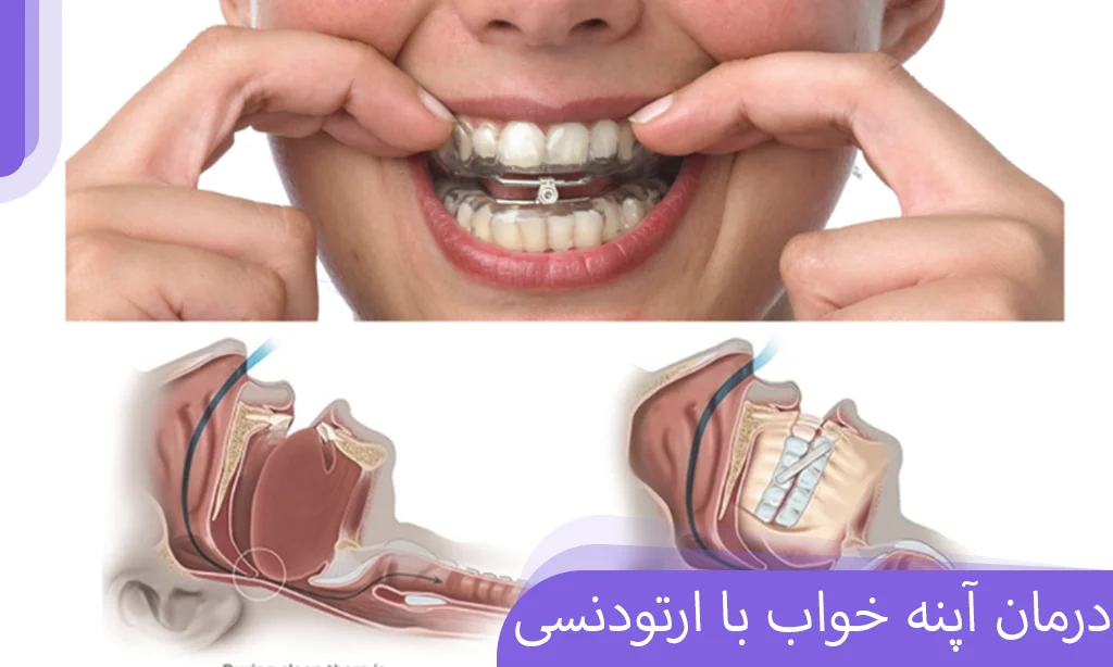 درمان آپنه خواب با ارتودنسی