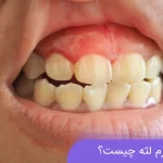 علت ورم لثه و درمان های خانگی آن