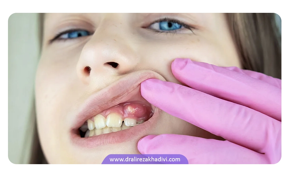 عفونت های شدید دندان ها از علت های غیر مستقیم بادکردن لثه است.