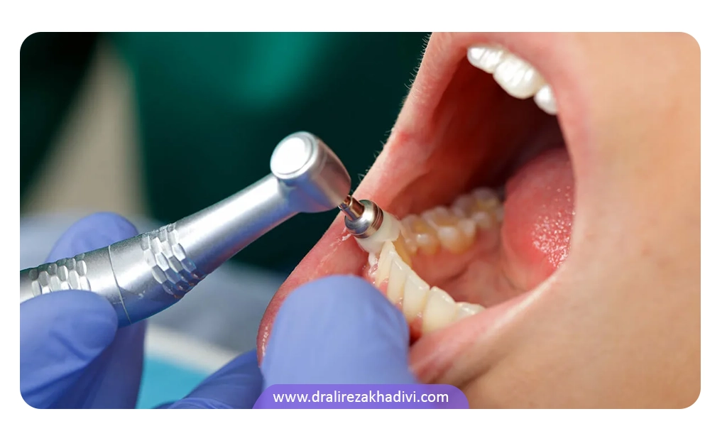 در صورت شدید شدن مشکل ورم لثه، بهتر است برای درمان به دندانپزشک مراجعه کرد.