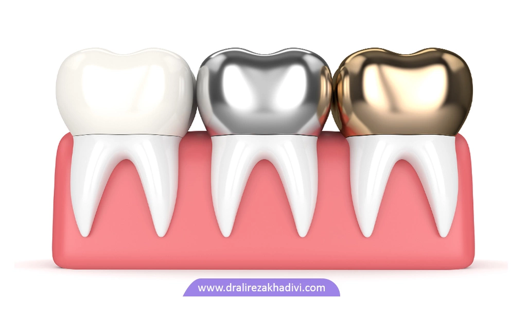 انواع روکش دندان در جنس های فلزی و سرامیکی