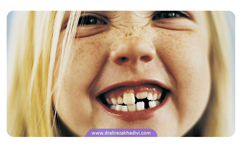 عوارض دندان قروچه در کودکان