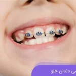 ارتودنسی دندان جلو، راهی برای لبخند زیباتر