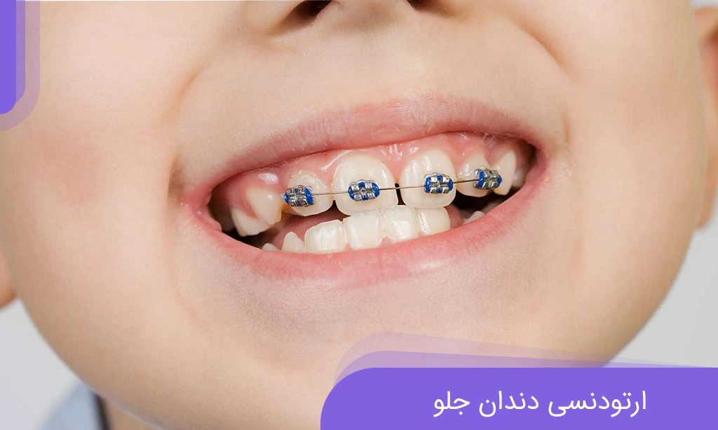 ارتودنسی دندان جلو، راهی برای لبخند زیباتر