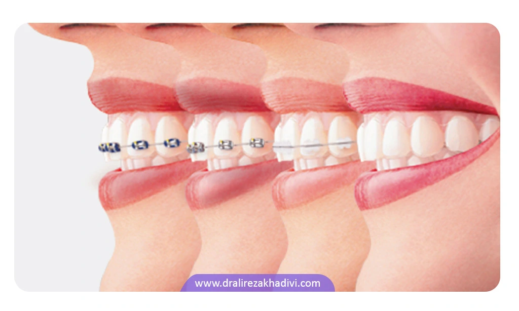 ارتودنسی دندان جلو هم جنبه زیبایی دارد هم درمانی