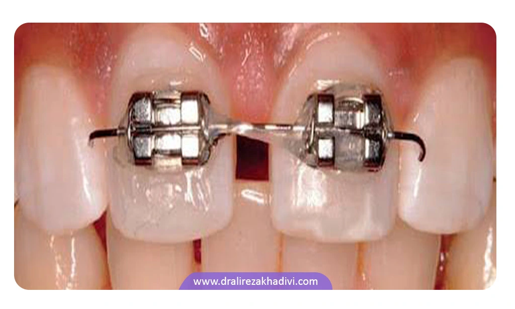 ارتودنسی دندان های جلو به جلوگیری از مشکلات لثه و بهبود تکلم کمک می کند