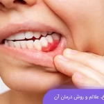 عفونت لثه یکی از مشکلات رایج دهان و دندان است.